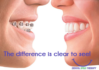 clear-braces-pompano-beach-invisalign.png