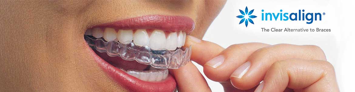 invisalign-clear-braces-pompano-beach-florida.jpg