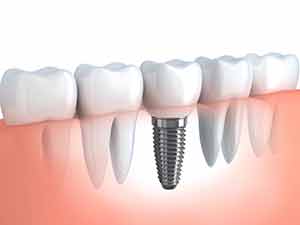 Dental Implants Dentist Pompano Beach Florida